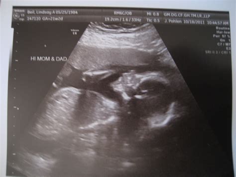 Baby Beil 22 Week Ultrasound