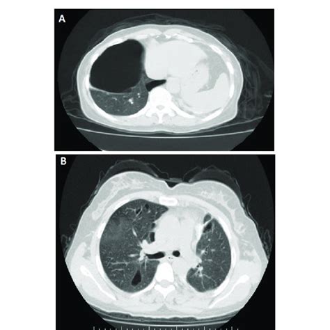 Bullous Lesion Localized In The Lower Lobe Of The Right Lung And