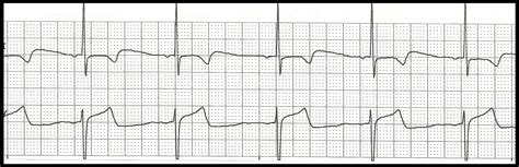 Float Nurse: EKG Rhythm Strip Quiz 98: Junctional rhythms
