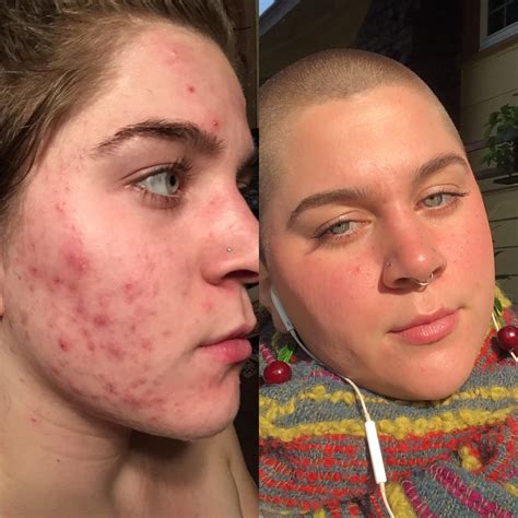 Selfie Banda Almost 10 Years Of Cystic Acne 22 Yo And Doing Much