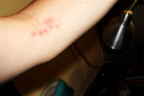 What Do Bed Bug Bites Look Like Rox Bugs