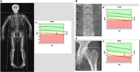 The concept is of mass of mineral per volume of bone (relating to density in the physics sense). Frontiers | Lower Bone Mineral Density in Patients with ...