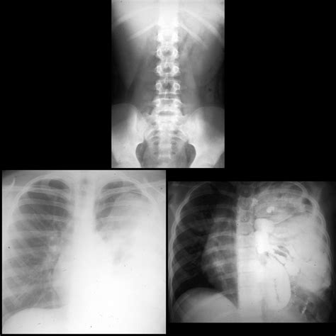 Congenital Diaphragmatic Hernia Cdhs Pacs