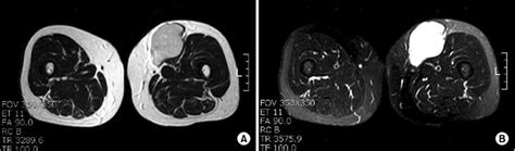 Mri Images Of The Mass In The Thigh A Mri Shows 66×55×47 Cm Sized