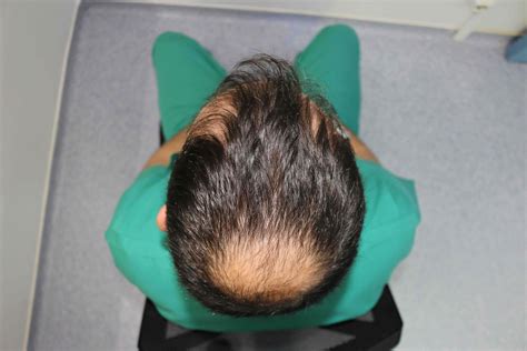 Balding Crown The Early Signs Hair Transplant Turkey