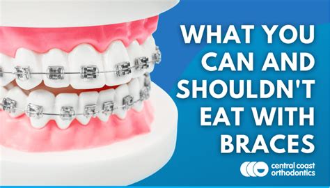 what you can and shouldn t eat with braces central coast orthodontics