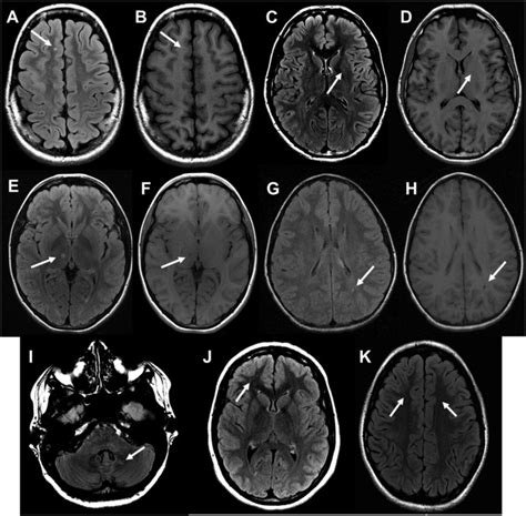Brain Mri Findings In Children And Adolescents With Fabry Disease