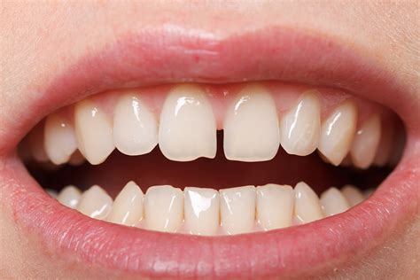 How To Fix Gap Teeth Exploring Different Ways Top Globe News