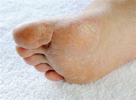 7 Common Skin Problems Of The Feet