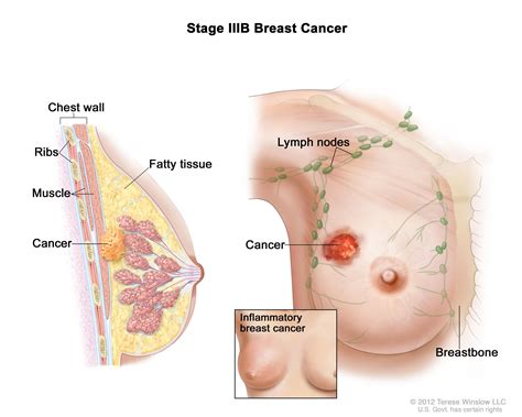 What does it mean if there is cancer in the lymph glands? Breast Cancer Treatment (PDQ®)—Patient Version - National ...