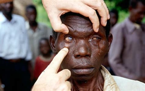 Over 1m Blind Adults Live In Nigeria Nzelu Vanguard News