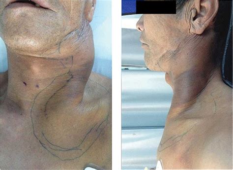 Management Of Extracranial Carotid Artery Aneurysm A Report Of Four Cases
