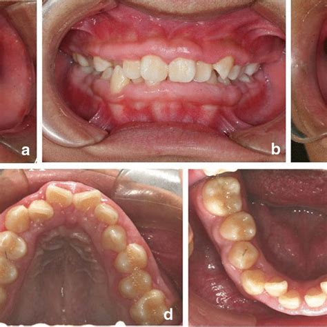 Gingival Redness And Hyperplasia One Year After Orthodontic Treatment