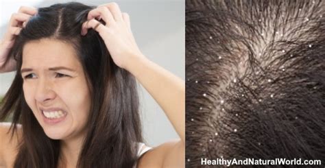 Dandruff Vs Dry Scalp Find The Differences And The Best Treatments