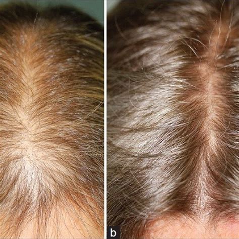 Finasteride 5 Mg Day Treatment Of Patterned Hair Loss In Normo