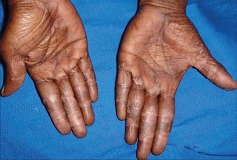 Hand And Foot Syndrome Secondary To Capecitabine Indian Journal Of
