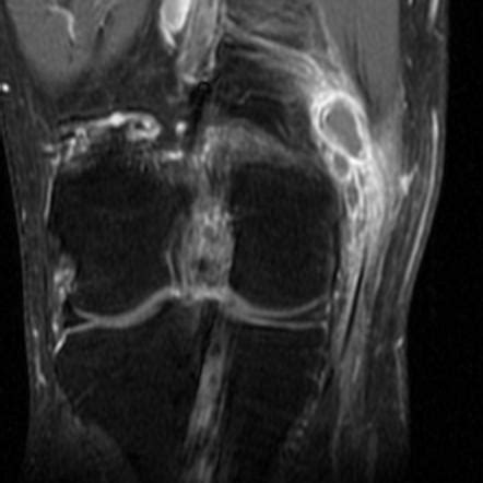 Pes Anserinus Myotendinous Injury Radiology Case Radiopaedia Org