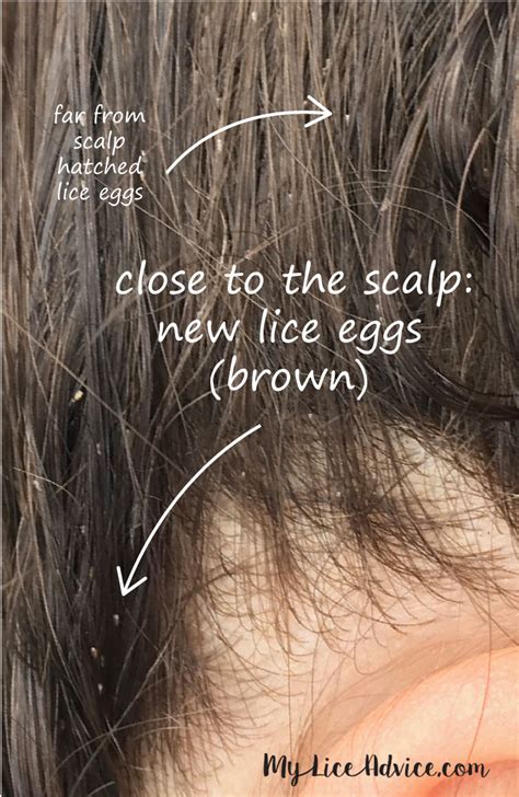 What Does Lice Look Like In Dark Hair
