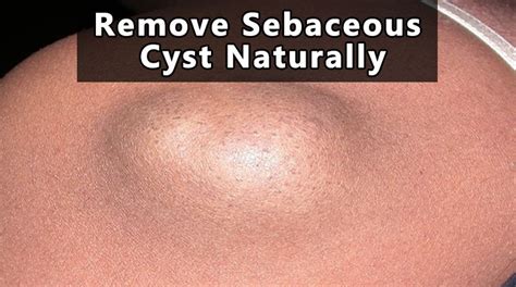 Remove Sebaceous Cyst Naturally At Home Fast And Easy Home Remedies