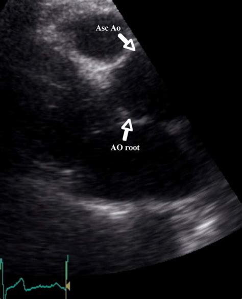 Parasternal Long Axis View Showing A Dilated Aortic Root And Ascending Download Scientific