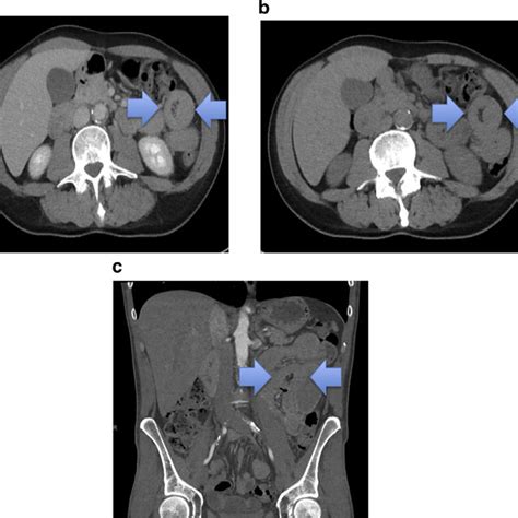 Abdominal Ct Scan Showing „target‟ Appearance Of Jejuno Jejunal