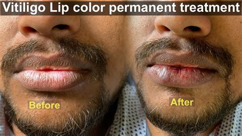 Permanent Lip Color Correction Treatment For Dark Lips And White Patch