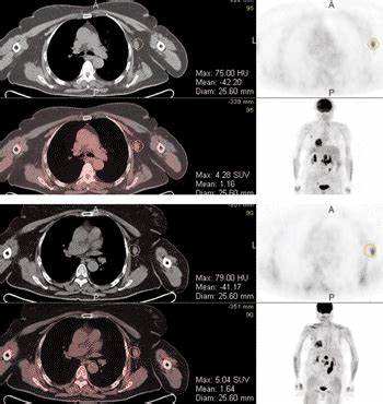 Диета при пэт кт что