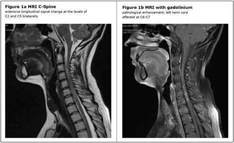 Cureus A Diagnosis Of Multiple Sclerosis Following Whiplash Injury