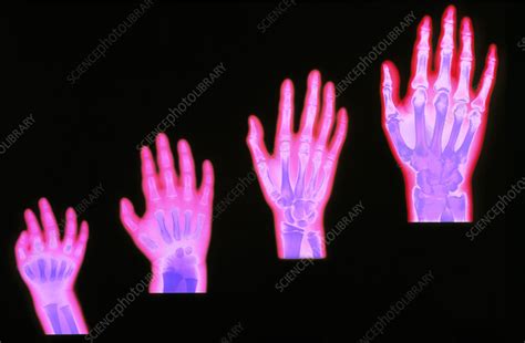 X-ray of hand bone growth: child to adult - Stock Image P116/0308