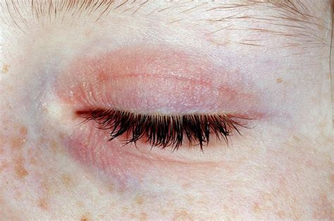 Eczema On The Eyelid Photograph By Dr P Marazziscience Photo Library