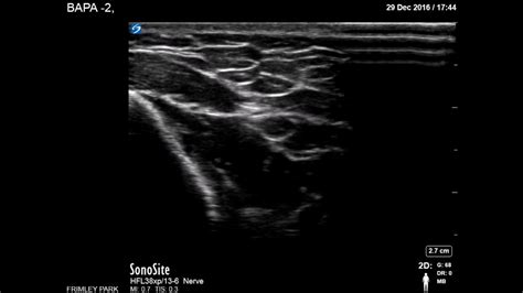 Radial Nerve Scanning In Spiral Groove Youtube