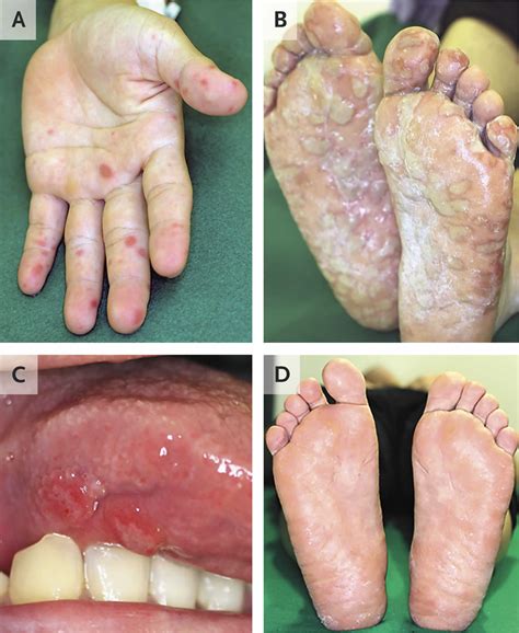 mild hand foot and mouth disease adult