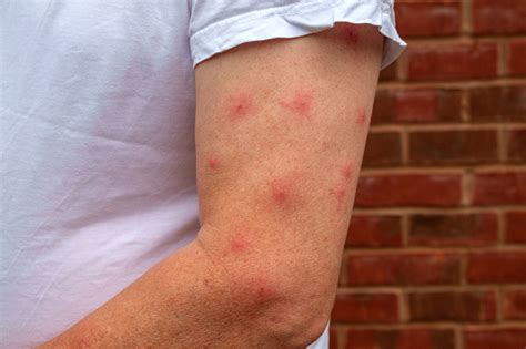 Allergic Reaction To Mosquito Bites Stock Photo Download Image Now