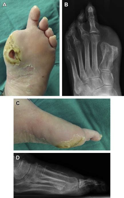 Partial Foot Amputations For Salvage Of The Diabetic Lower Extremity