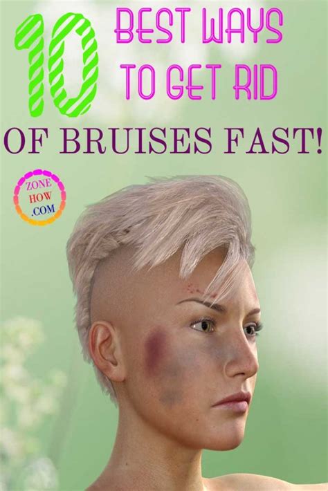 How To Get Rid Of Bruises Fast And Treat Them 10 Best Tips June 2022