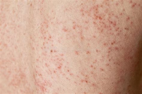 Éruption Allergique Sur La Peau Femme Avec Le Problème De Dermatologie
