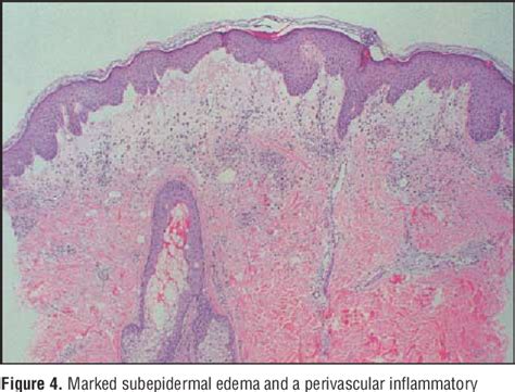 Figure 1 From Sweet Syndrome Acute Febrile Neutrophilic Dermatosis