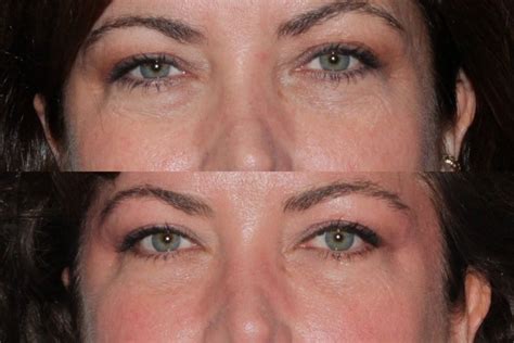 Restylane Filler Treatment By Dermatologists In San Diego