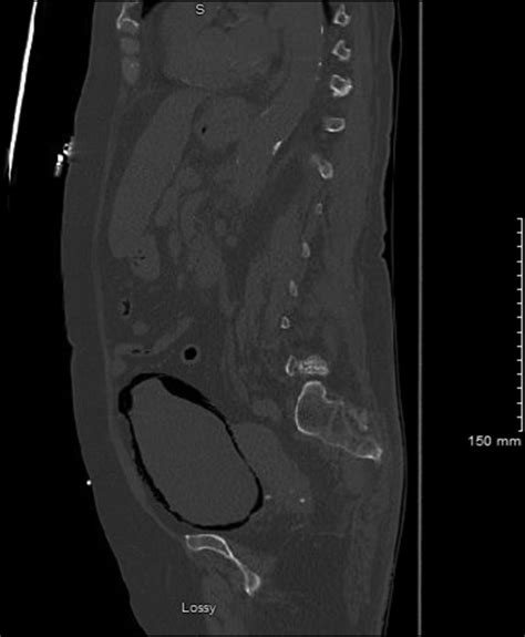 Unusual Association Of Emphysematous Cystitis And Chronic Alcoholism