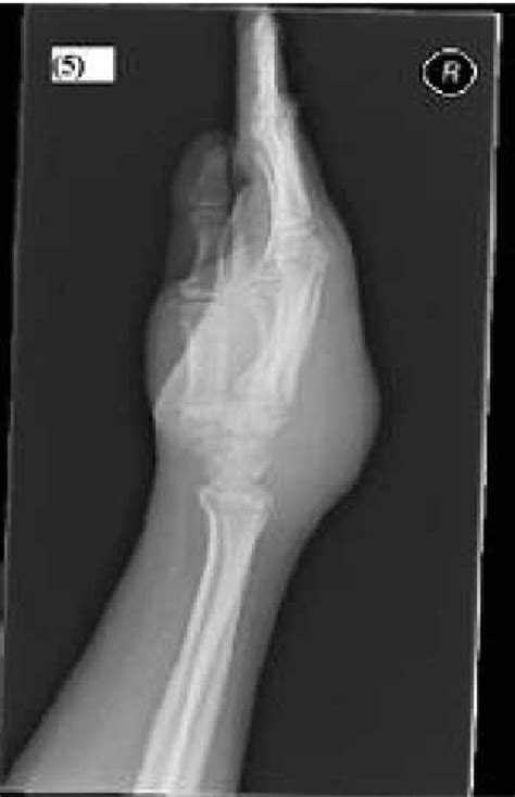 X Ray Of Right Hand And Wrist Joint Ap Projection