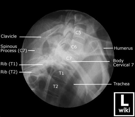 Cervical Spine Radiographic Anatomy Wikiradiography Diagnostic