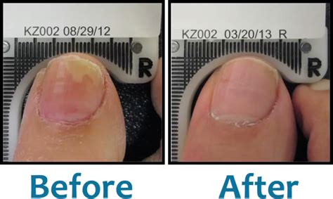 Lunula Fungal Nail Cold Laser Treatment For Athletes Foot