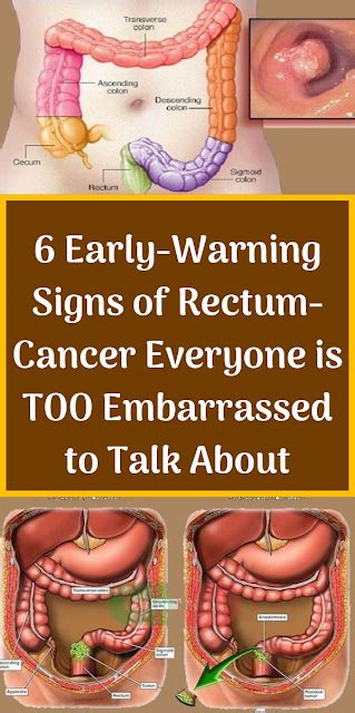 Early Warning Signs Of Rectum Cancer Everyone Is TOO Embarrassed To