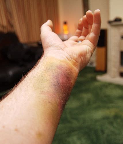 Bruised Wrist More Practicing Fake Bruise Attempt No 2 Flickr