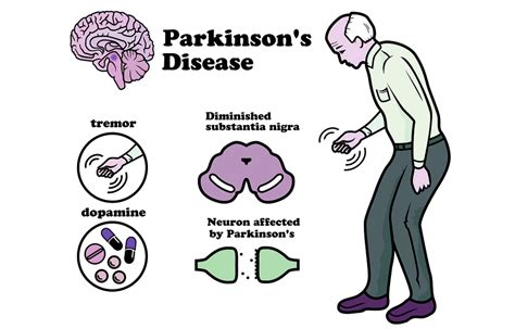 Νόσος του Parkinson Emedigr Πρόληψη Υγείας