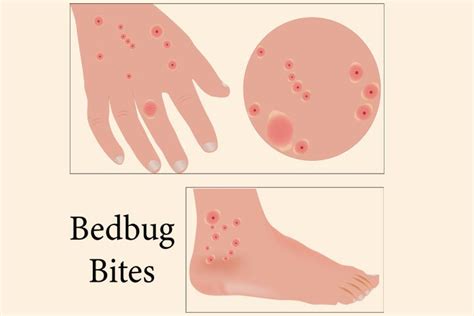 Bed Bug Bites On Kids Picture Causes Treatment And Remedies