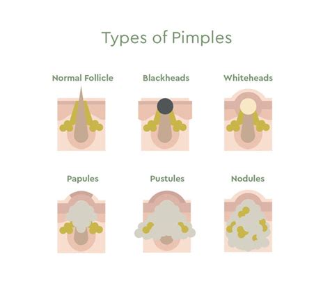 How To Get Rid Of Pimples Acne Fast 5 Facts To Know Bioclarity