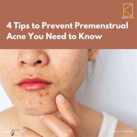 4 Tips To Prevent Premenstrual Acne You Need To Know