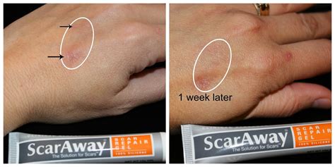 Scar Away Scar Repair Gel Heals New And Old Scars