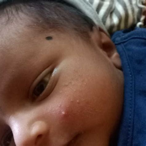 My Son Is 10 Months Old Nad Since Birth He Has This Pimpleacne Kinda